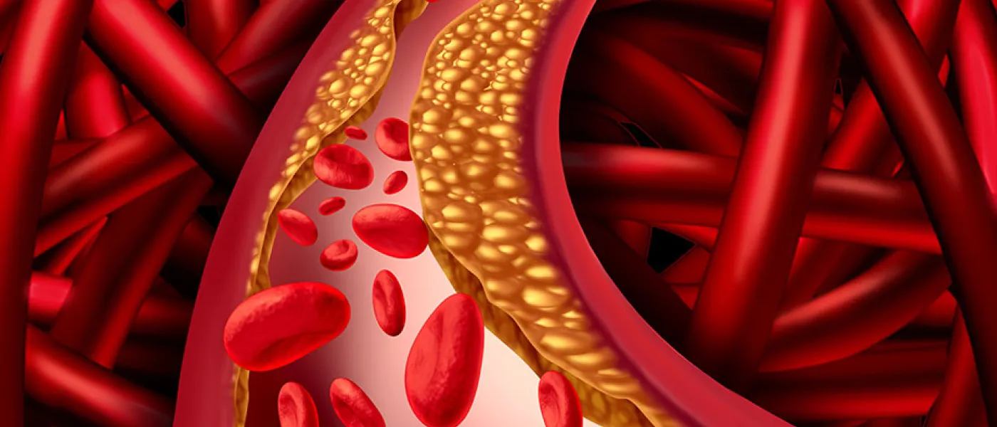 Colesterol y aterosclerosis