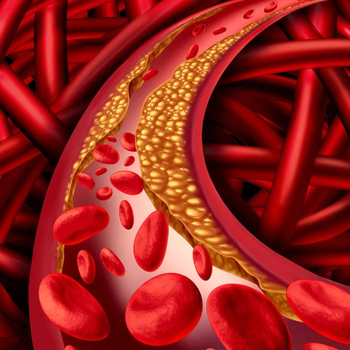 Colesterol y aterosclerosis