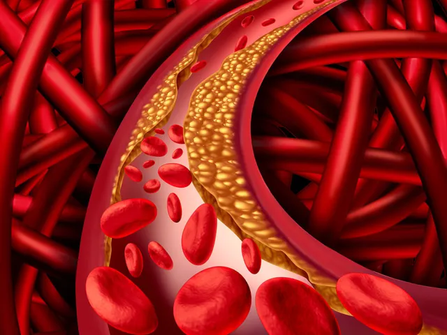 Colesterol y aterosclerosis